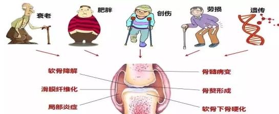骨关节炎