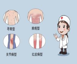 银屑病1