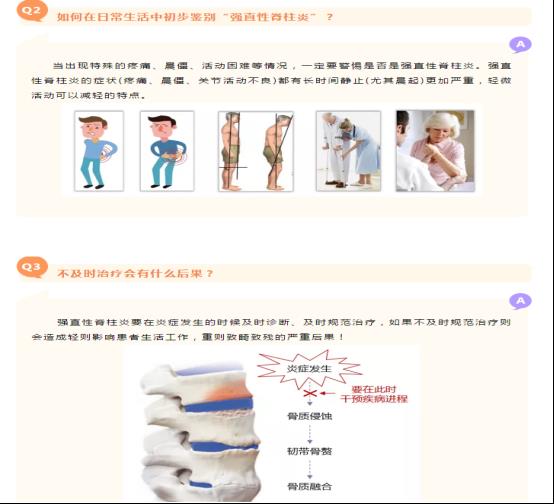 强直性脊柱炎